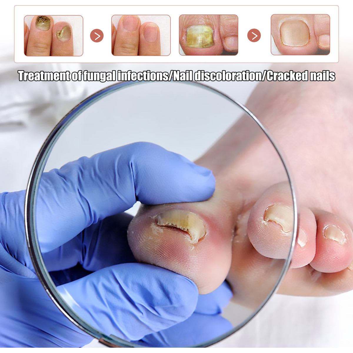 Anti-fungal Foot Soak, Foot Gray Nail Repair Bright Nail Deodorizer Foot Care Foam Tablets