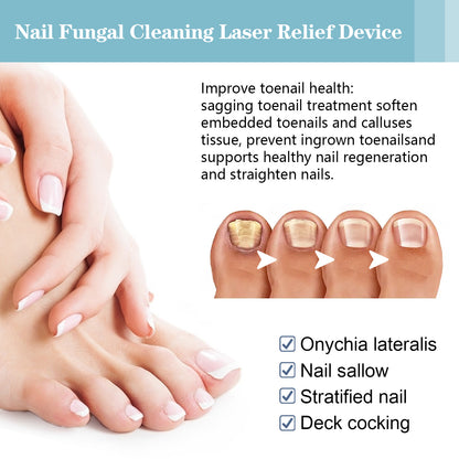 Nail Fungal Cleaning Laser Relief Device, Gray Nail Bad Nail Thickening Soft Nail Bright Nail Care Instrument