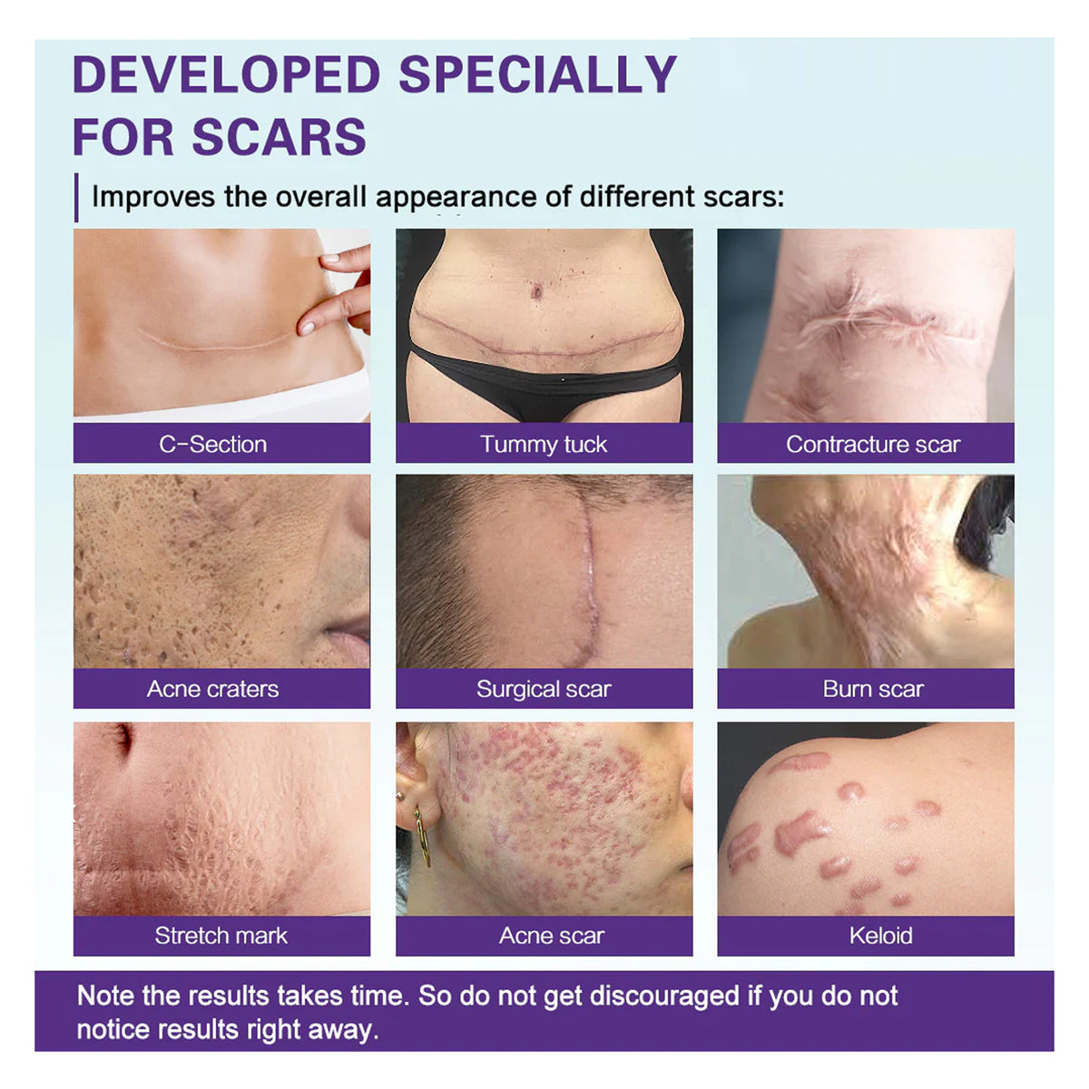 High-quality Silicone Scar Gel, Lighten Acne Mark Scar Repair Skin Smoothing Care Cream