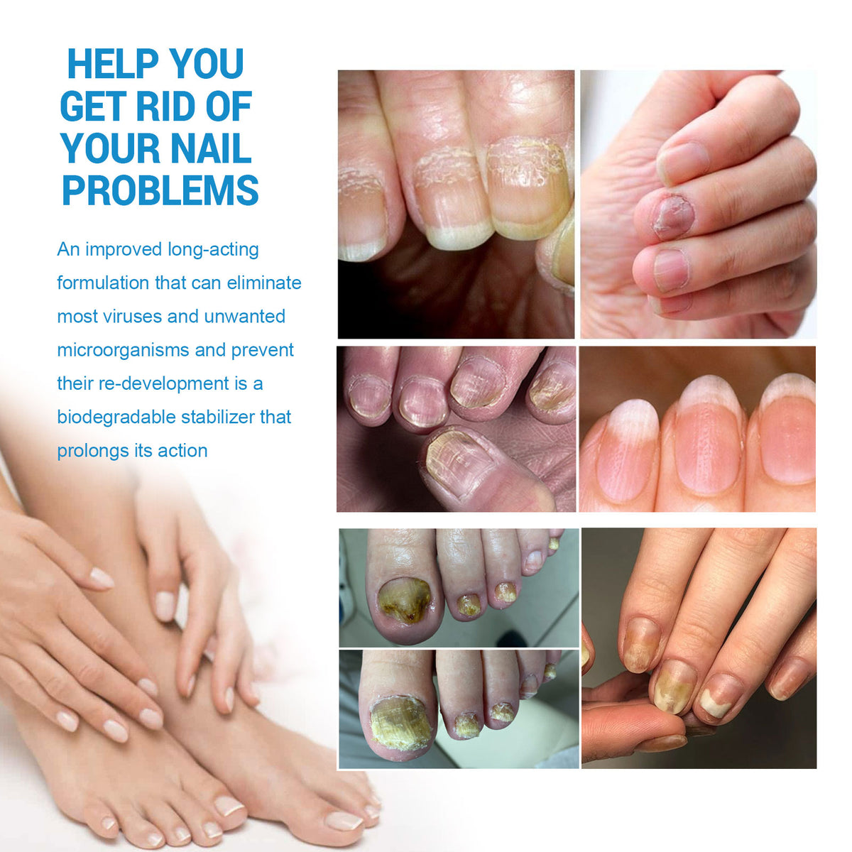 Anti-Fungal Disinfectant Nail Fungus Removal, Hand And Foot Gray Nails Clean Repair Soft Nails Thicken Nails Shine Nails Spray
