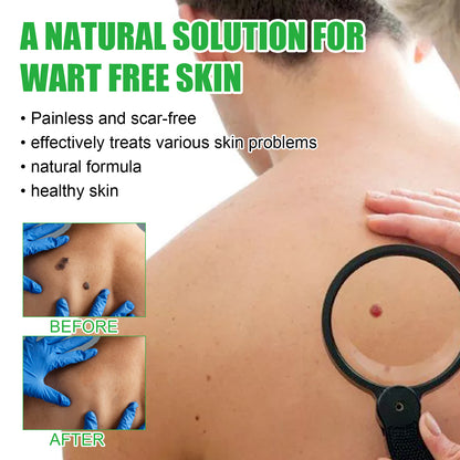 Mole Remover Soap, Repair Meat Granules Corns And Dark Moles, Smooth Skin Anti-wart Cleansing Soap