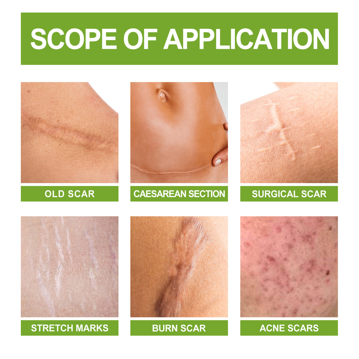 Scar Repair Serum Reduces Scar Acne Mark Pregnancy Surgery Scar Repair Smooth Skin Care