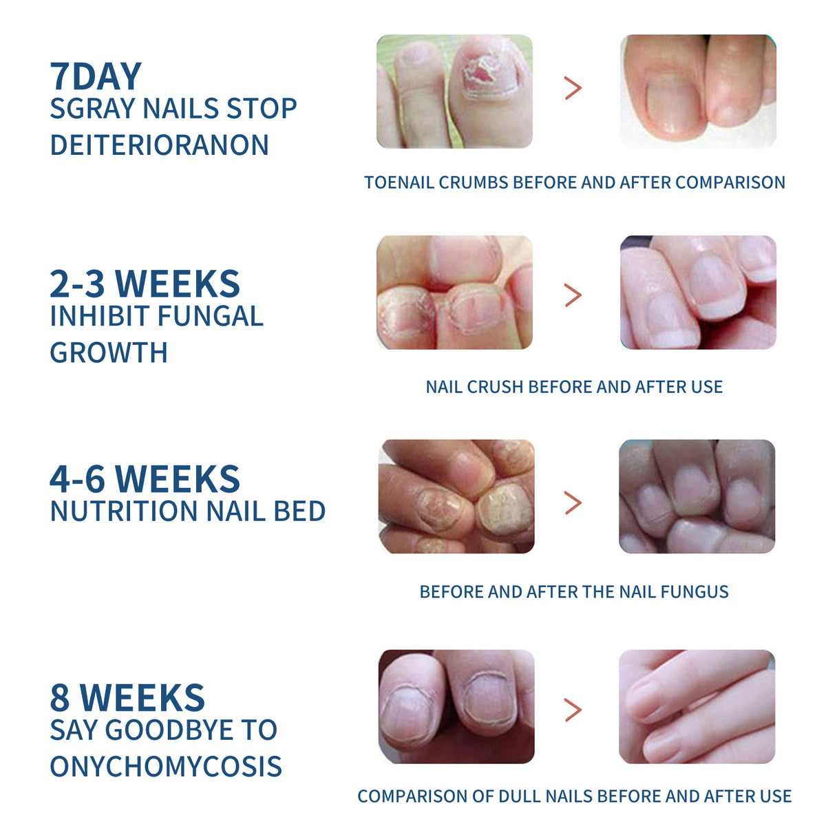 Fungal Nail Patches, Toenail Care Soft Nail, Inlay Nail And Thickening Nail Repair Patch