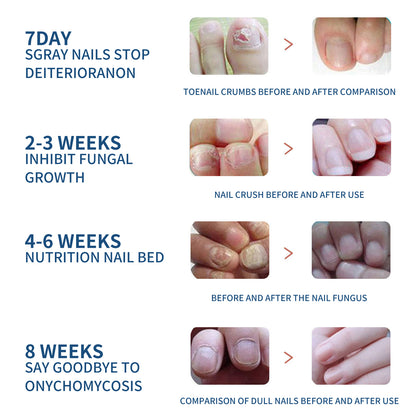 Fungal Nail Patches, Toenail Care Soft Nail, Inlay Nail And Thickening Nail Repair Patch