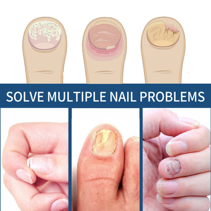 Fungal Nail Patches, Toenail Care Soft Nail, Inlay Nail And Thickening Nail Repair Patch